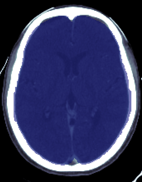 Example slice from a CT scan in the MNI space with brain mask